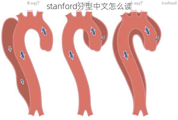 stanford分型中文怎么读