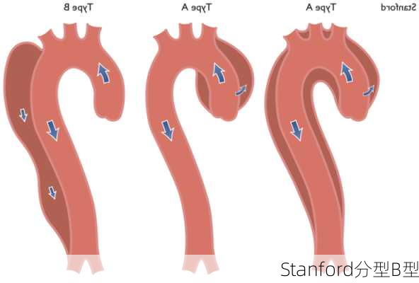 Stanford分型B型