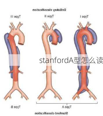 stanfordA型怎么读