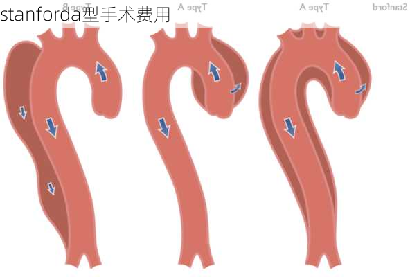 stanforda型手术费用