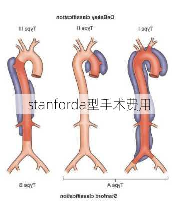 stanforda型手术费用