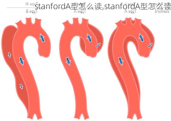 stanfordA型怎么读,stanfordA型怎么读